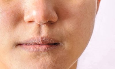 Ciclo menstrual irregular favorece problemas de pele – 08/09/2025 – Equilíbrio