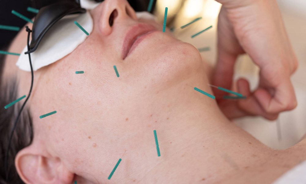 Acupuntura facial se populariza como alternativa ao botox – 15/09/2025 – Equilíbrio