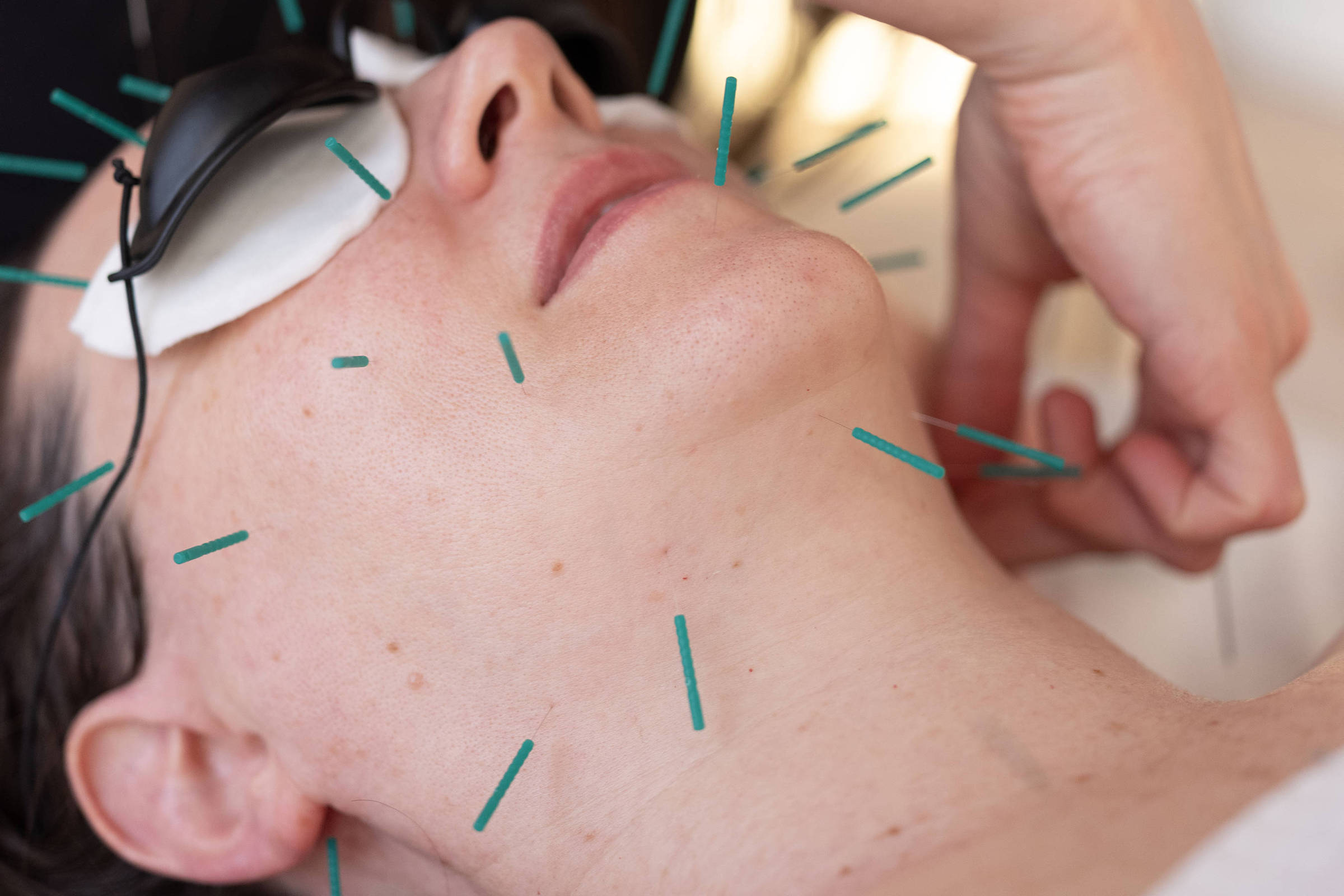 Acupuntura facial se populariza como alternativa ao botox – 15/09/2025 – Equilíbrio