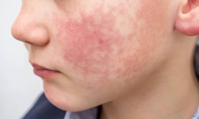 Entenda o que é a doença da face esbofeteada – 22/09/2025 – Equilíbrio e Saúde