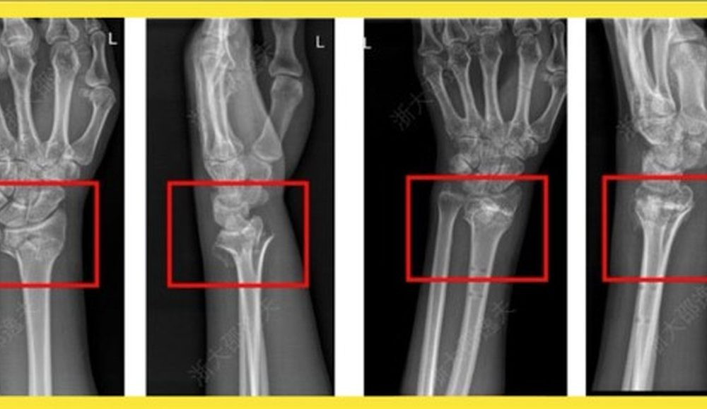China diz ter revolucionado a ortopedia com ‘cola óssea’ que resolve fraturas ‘em minutos’