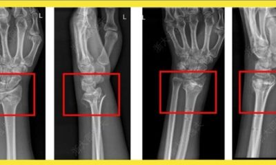 China diz ter revolucionado a ortopedia com ‘cola óssea’ que resolve fraturas ‘em minutos’