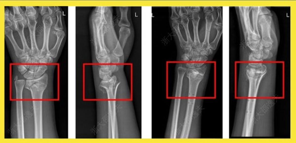 China diz ter revolucionado a ortopedia com ‘cola óssea’ que resolve fraturas ‘em minutos’