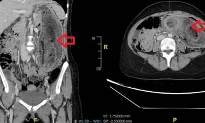 Médicos retiram bola de cabelo gigante do estômago de adolescente com ‘síndrome de Rapunzel’