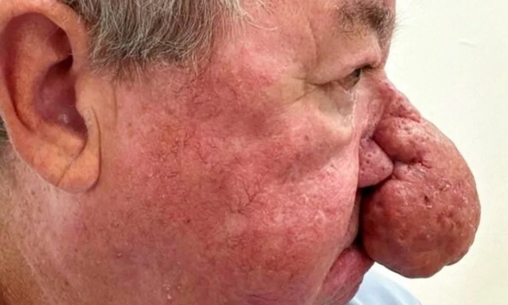 Escocês com nariz gigantesco se submete a cirurgia para poder voltar a beijar a esposa