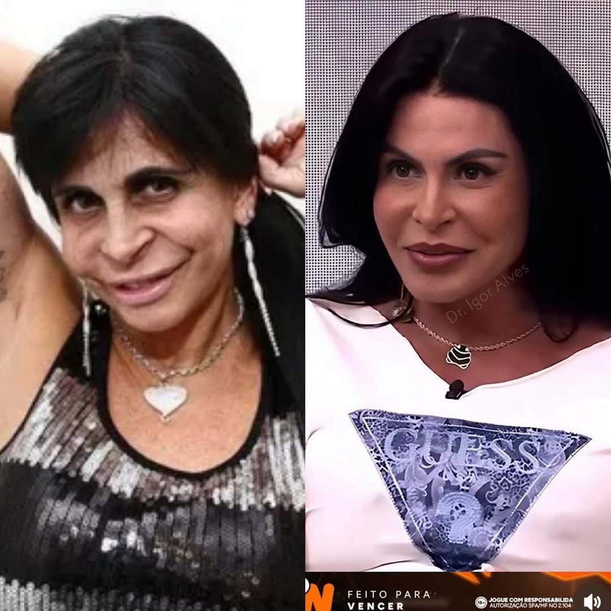 Gretchen mostra resultado de blefaroplastia: ‘Estou apaixonada’