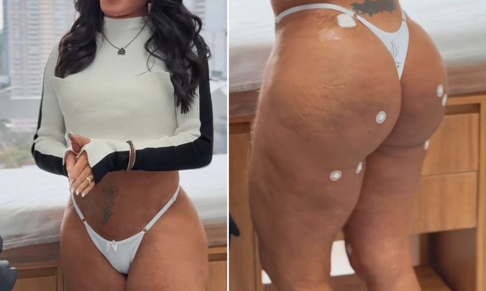 Gretchen mostra tratamento no bumbum com PMMA