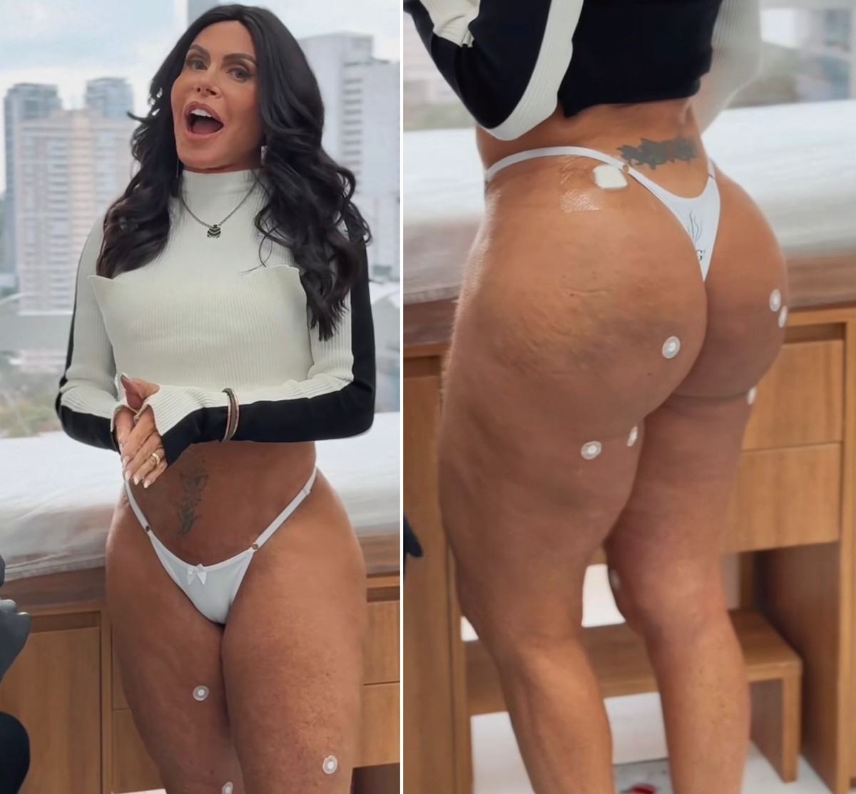 Gretchen mostra tratamento no bumbum com PMMA