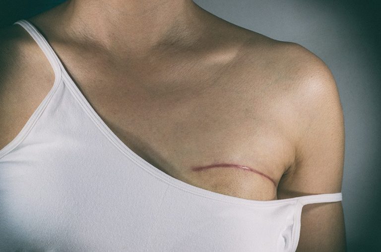 Nova lei garante fisioterapia no SUS a pacientes que retirarem mama – Notícias