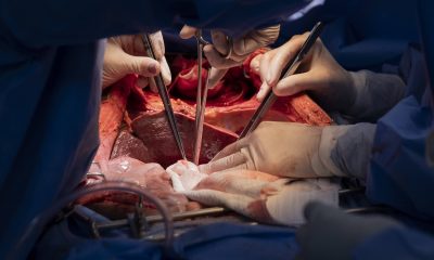 Droga pode melhorar qualidade de rins para transplante – 07/01/2026 – Equilíbrio e Saúde